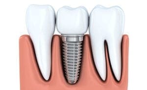 Dental Implants